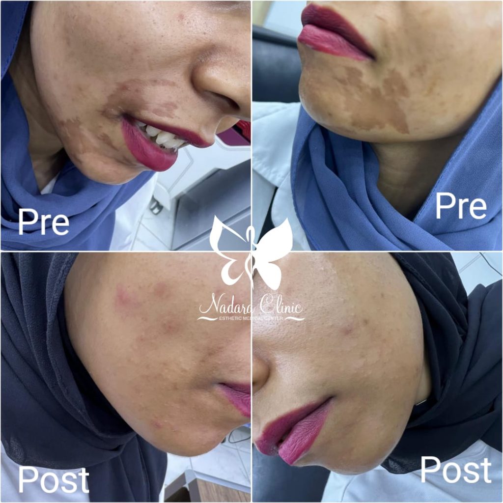 Treating the effects of burns